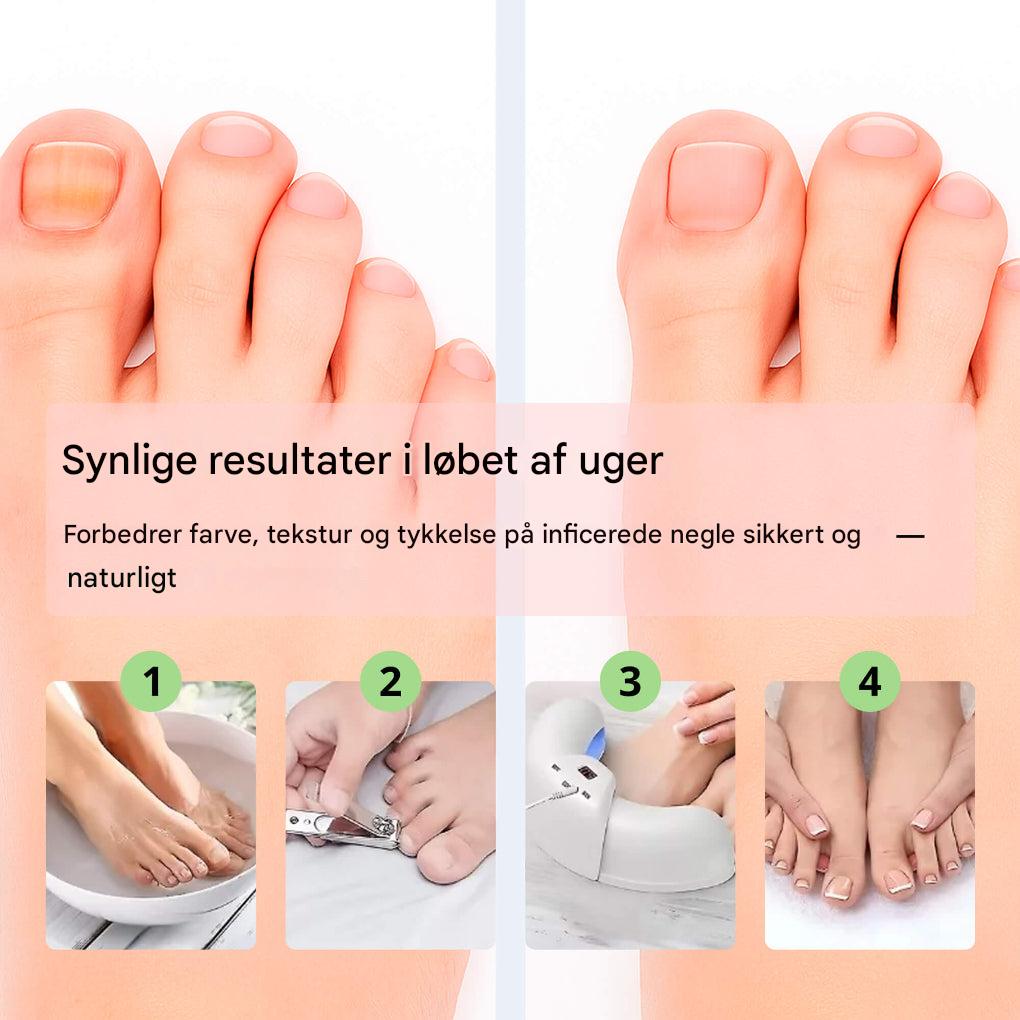 Laserapparat til fjernelse af neglesvamp