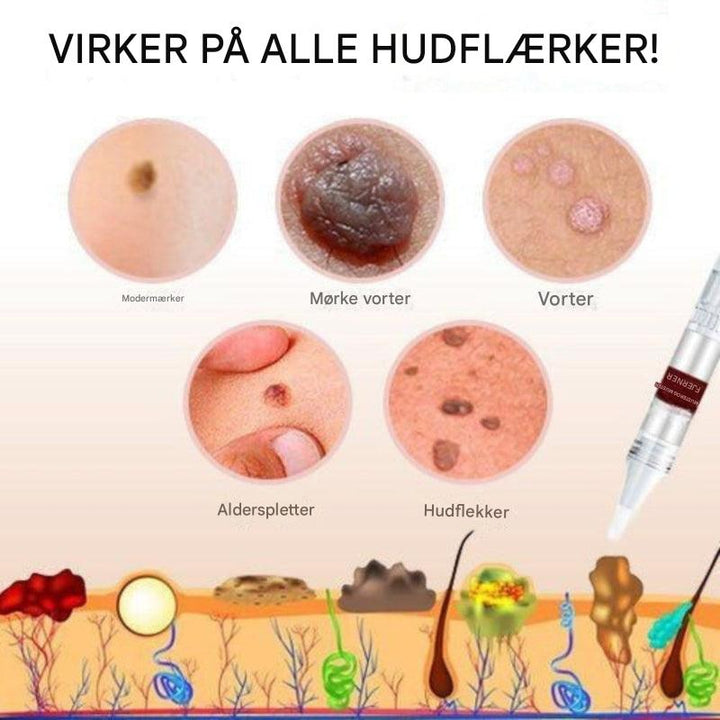 Fjerner mærker og modermærker