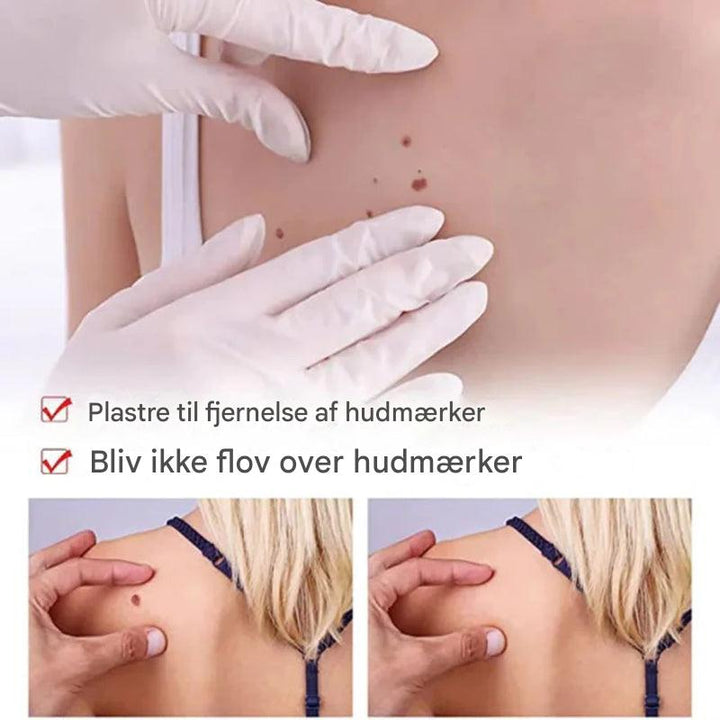 Fjerner mærker og modermærker