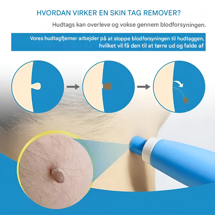 Skin Tag Fjernelsessæt
